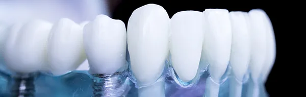 Implantodontia na Vitaly Odontologia